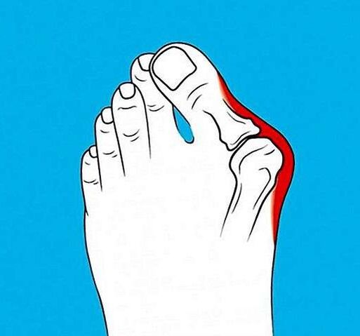 артроз сустава на пальце ноги